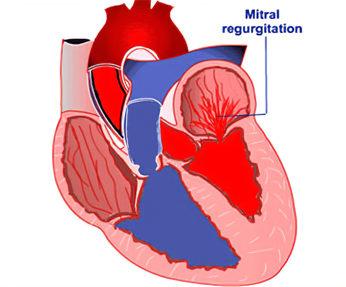 Ayurvedic Treatment For Heart Valve Regurgitation Ayurvedic Treatment For Heart Valve Regurgitation